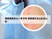 银屑病用忌口一辈子吗 银屑病不忌口比忌口好