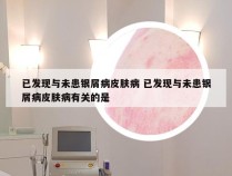 已发现与未患银屑病皮肤病 已发现与未患银屑病皮肤病有关的是