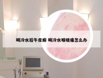 喝冷水后牛皮癣 喝冷水喉咙痛怎么办