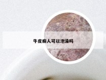 牛皮癣人可以泡澡吗