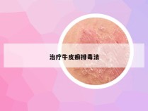 治疗牛皮癣排毒法