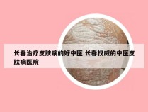 长春治疗皮肤病的好中医 长春权威的中医皮肤病医院