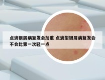 点滴银屑病复发会加重 点滴型银屑病复发会不会比第一次轻一点