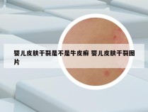 婴儿皮肤干裂是不是牛皮癣 婴儿皮肤干裂图片