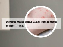 奶奶有牛皮癣会遗传给孙子吗 妈妈牛皮肤癣会遗传下一代吗