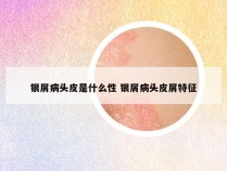 银屑病头皮是什么性 银屑病头皮屑特征