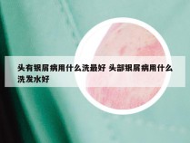 头有银屑病用什么洗最好 头部银屑病用什么洗发水好