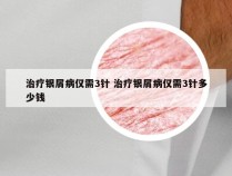 治疗银屑病仅需3针 治疗银屑病仅需3针多少钱