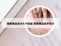 银屑病治愈分几个阶段 银屑病治愈率多少