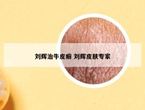 刘辉治牛皮癣 刘辉皮肤专家