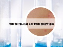 银屑病获科研奖 2021银屑病研究进展