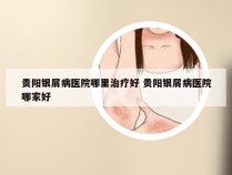 贵阳银屑病医院哪里治疗好 贵阳银屑病医院哪家好