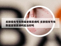 皮肤镜有专有数据查银屑病吗 皮肤镜有专有数据查银屑病吗能治好吗