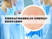生物制剂治疗银屑病要忌口吗 生物制剂治疗银屑病可以断根吗