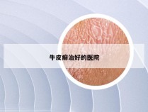 牛皮癣治好的医院