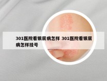 301医院看银屑病怎样 301医院看银屑病怎样挂号