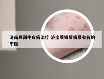 济南民间牛皮癣治疗 济南看银屑病最有名的中医