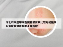 河北石家庄哪家医院看银屑病比较好的医院 石家庄看银屑病的正规医院