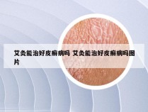艾灸能治好皮癣病吗 艾灸能治好皮癣病吗图片