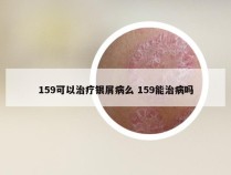 159可以治疗银屑病么 159能治病吗
