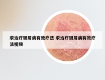 求治疗银屑病有效疗法 求治疗银屑病有效疗法视频