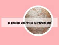 皮肤病银屑病能根治吗 皮肤病银屑图片