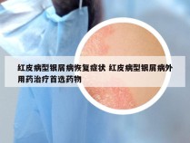 红皮病型银屑病恢复症状 红皮病型银屑病外用药治疗首选药物