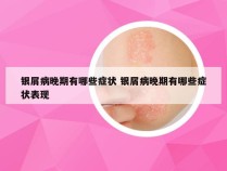 银屑病晚期有哪些症状 银屑病晚期有哪些症状表现