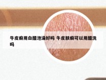 牛皮癣用白醋泡澡好吗 牛皮肤癣可以用醋洗吗