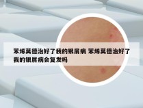 苯烯莫德治好了我的银屑病 苯烯莫德治好了我的银屑病会复发吗