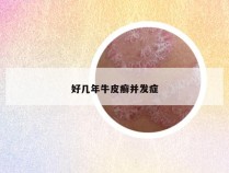 好几年牛皮癣并发症