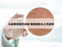 头部银屑病艾滋病 银屑病在头上传染吗