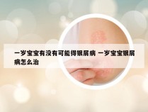 一岁宝宝有没有可能得银屑病 一岁宝宝银屑病怎么治