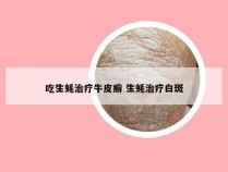 吃生蚝治疗牛皮癣 生蚝治疗白斑