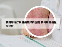 贵阳哪治疗银屑病最好的医院 贵州银屑病医院评价