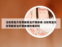 注射用复方甘草酸苷治疗银屑病 注射用复方甘草酸苷治疗银屑病效果好吗