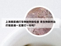 上海银屑病打生物制剂做检查 用生物制剂治疗银屑病一定要打一年吗?