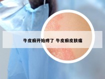 牛皮癣开始疼了 牛皮癣皮肤痛