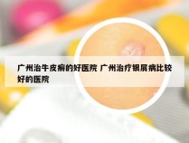 广州治牛皮癣的好医院 广州治疗银屑病比较好的医院