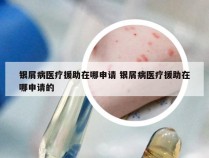 银屑病医疗援助在哪申请 银屑病医疗援助在哪申请的