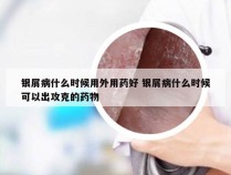 银屑病什么时候用外用药好 银屑病什么时候可以出攻克的药物