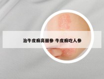 治牛皮癣高丽参 牛皮癣吃人参