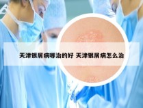 天津银屑病哪治的好 天津银屑病怎么治