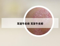 耳道牛皮癣 耳背牛皮癣