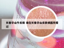 长春华山牛皮癣 谁在长春华山皮肤病医院看过