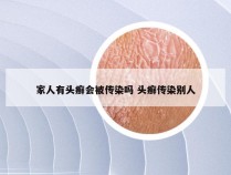 家人有头癣会被传染吗 头癣传染别人