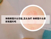 体般癣是什么引起,怎么治疗 体癣是什么症状有图片吗