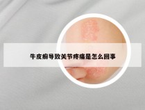 牛皮癣导致关节疼痛是怎么回事