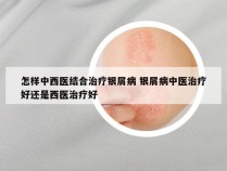 怎样中西医结合治疗银屑病 银屑病中医治疗好还是西医治疗好