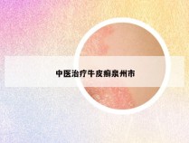 中医治疗牛皮癣泉州市